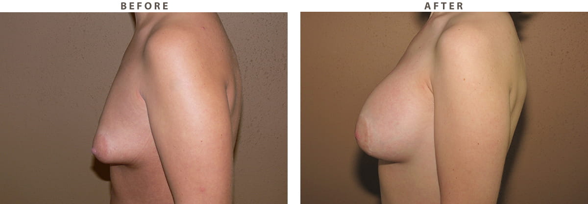 Tuberous breast Chicago - Before and After Pictures