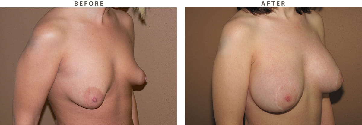 Tuberous breast Chicago - Before and After Pictures