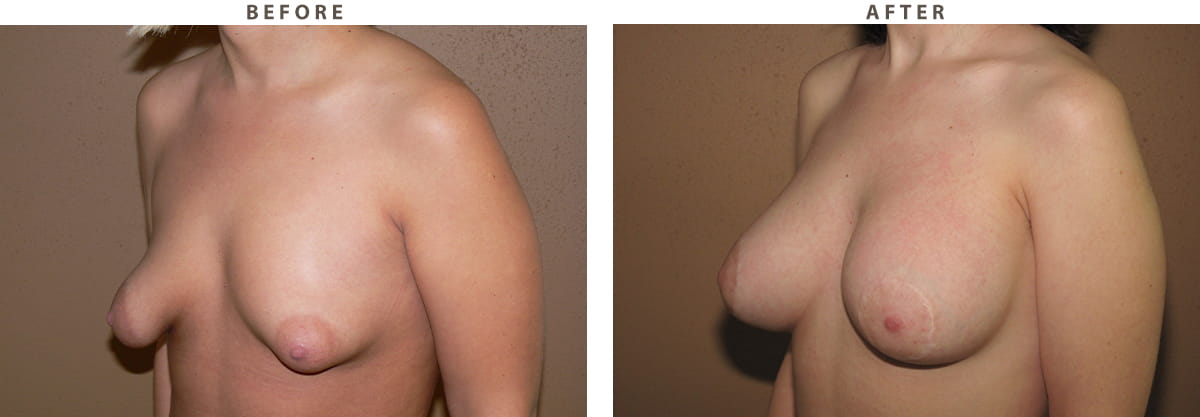Tuberous breast Chicago - Before and After Pictures