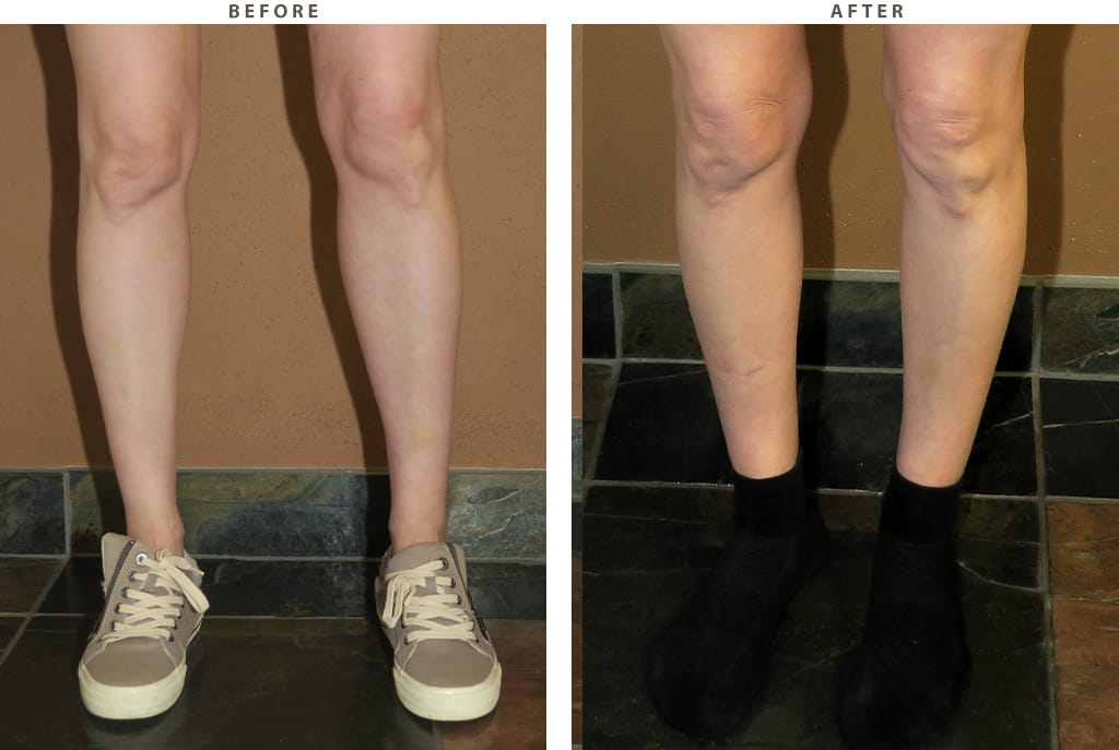 Calf implants Chicago - Before and After Pictures