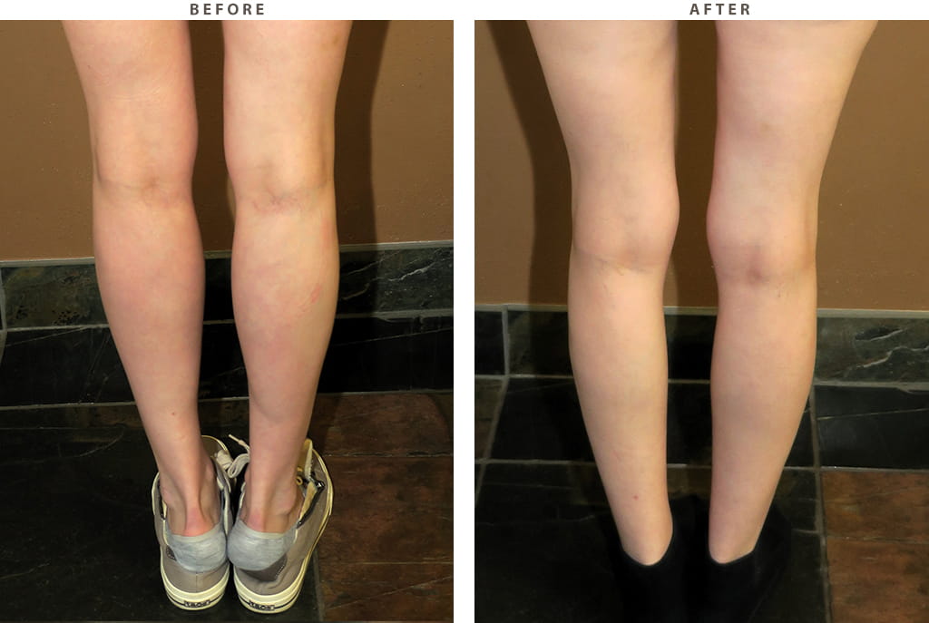 Calf implants Chicago - Before and After Pictures