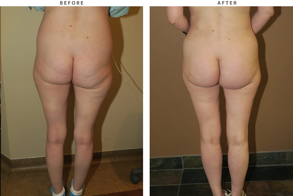 Buttock augmentation Chicago - Before and After Pictures