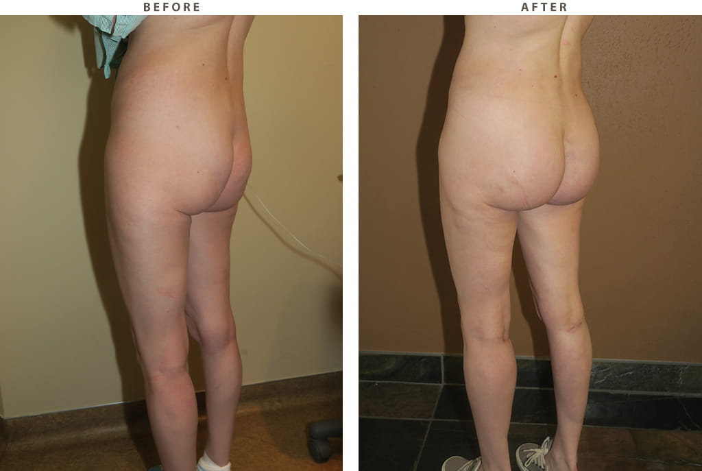 Buttock augmentation Chicago - Before and After Pictures