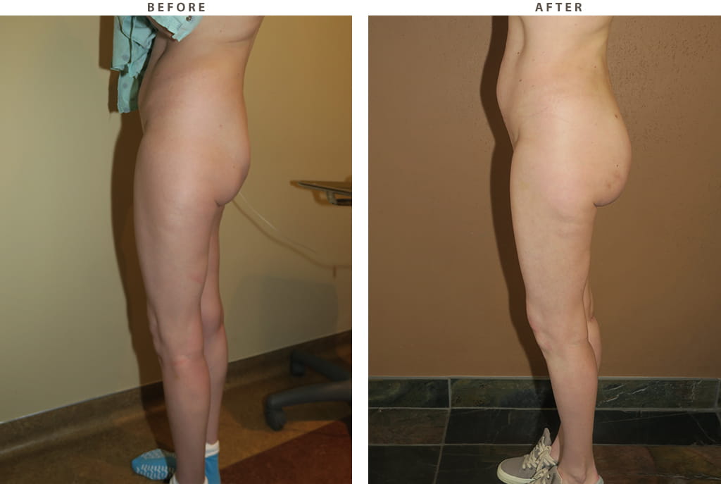 Buttock augmentation Chicago - Before and After Pictures