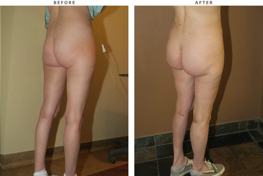 Buttock augmentation Chicago - Before and After Pictures