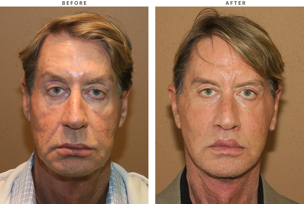Facelift Chicago - Before and After Pictures