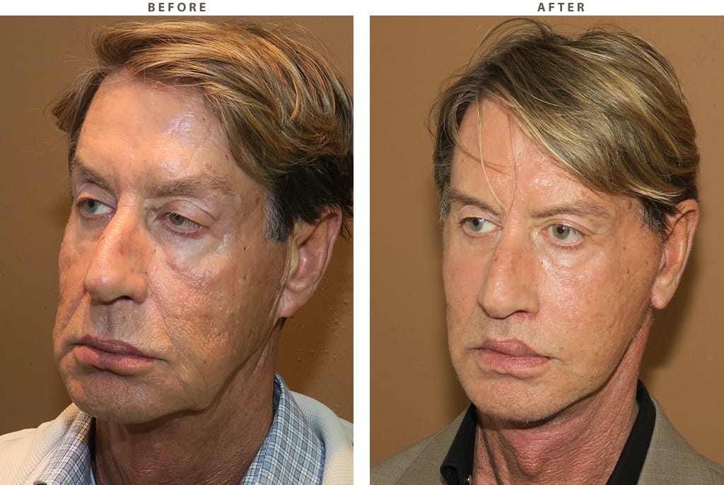 Facelift Chicago - Before and After Pictures