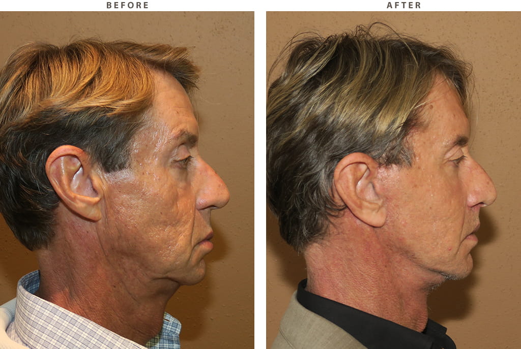 Facelift Chicago - Before and After Pictures