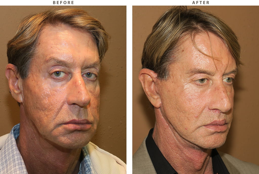 Facelift Chicago - Before and After Pictures