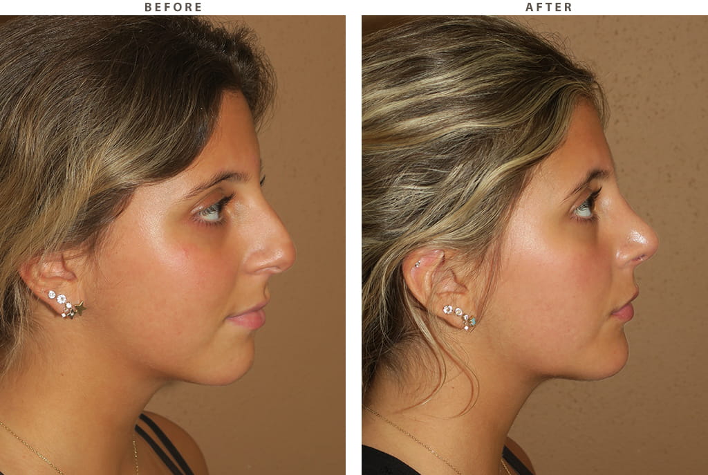 Rhinoplasty Chicago - Before and After Pictures