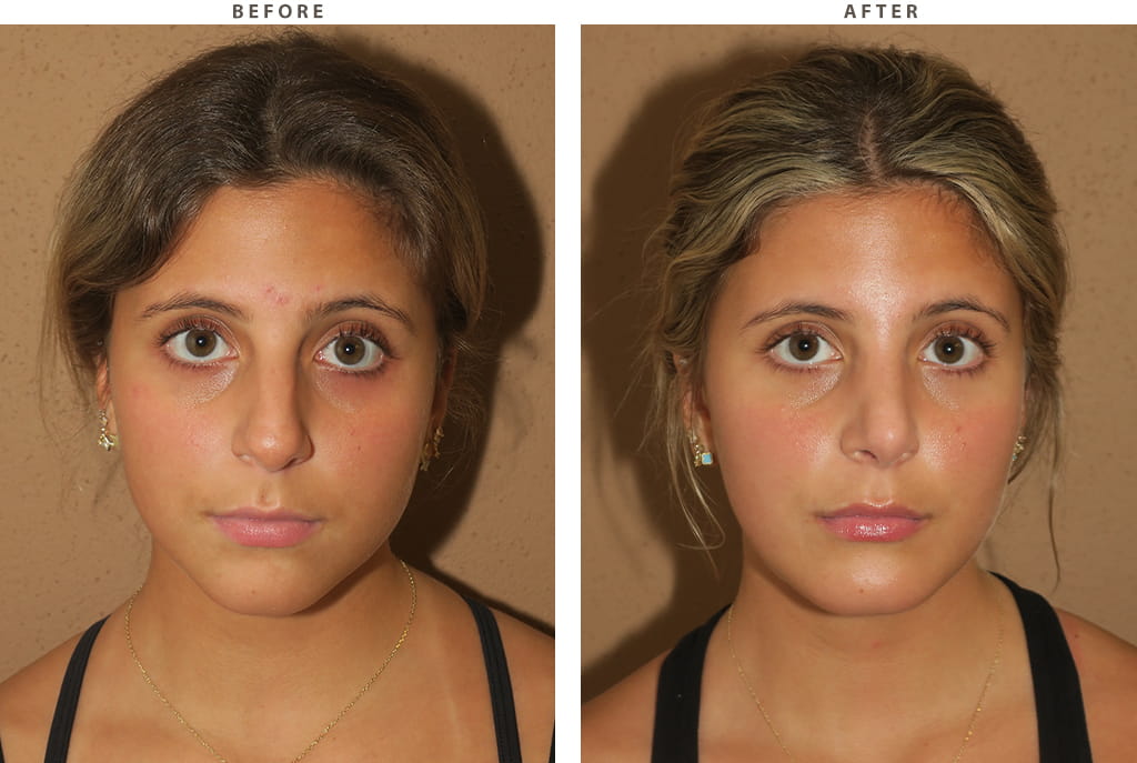 Rhinoplasty Chicago - Before and After Pictures