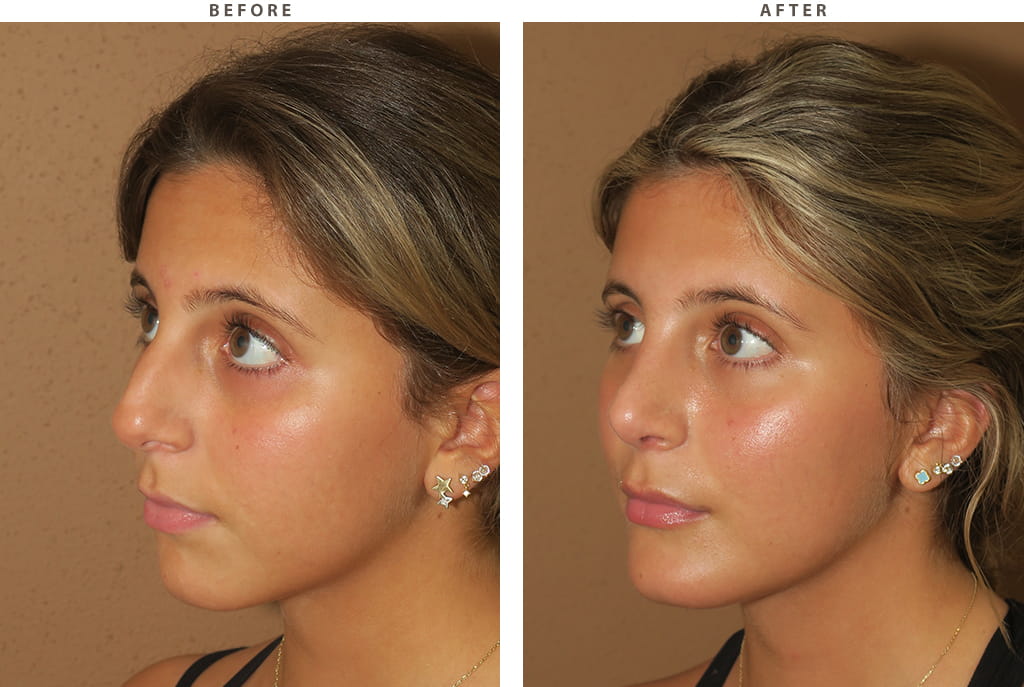 Rhinoplasty Chicago - Before and After Pictures