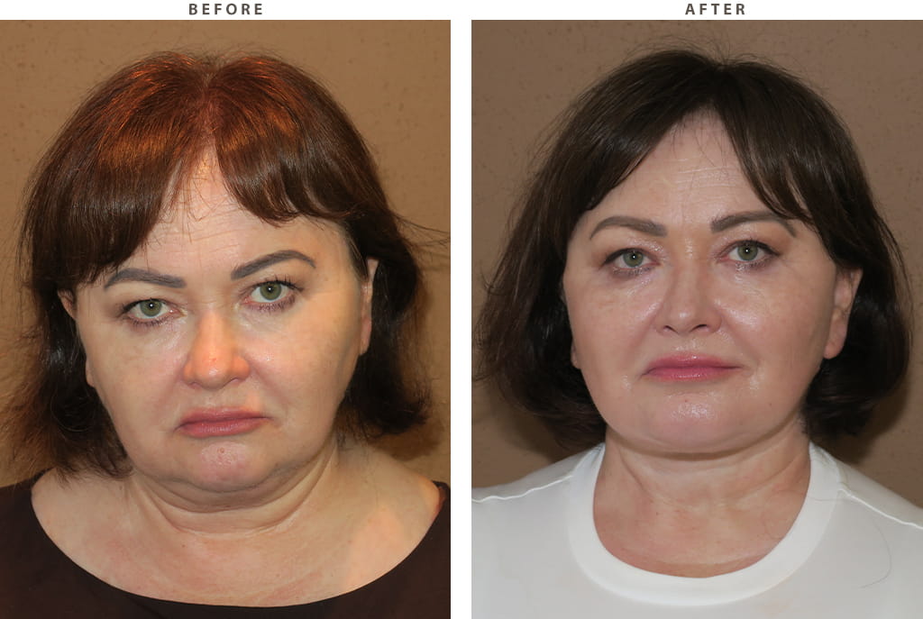 Midface lift Chicago - Before and After Pictures