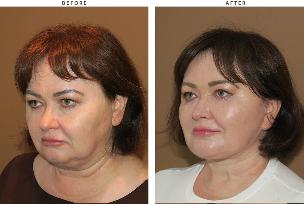 Midface lift Chicago - Before and After Pictures