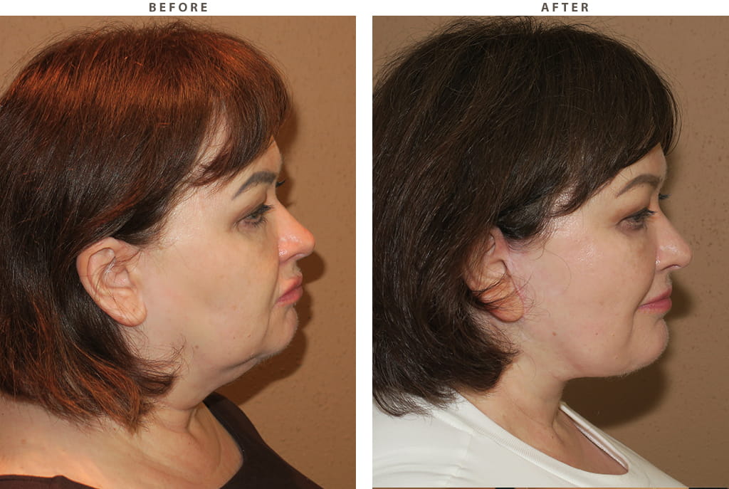 Midface lift Chicago - Before and After Pictures