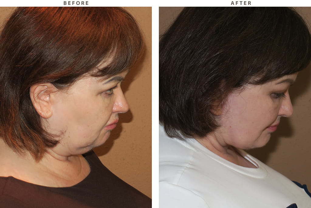 Midface lift Chicago - Before and After Pictures
