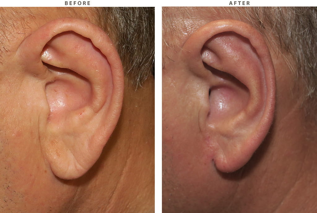Earlobe reduction Chicago - Before and After Pictures