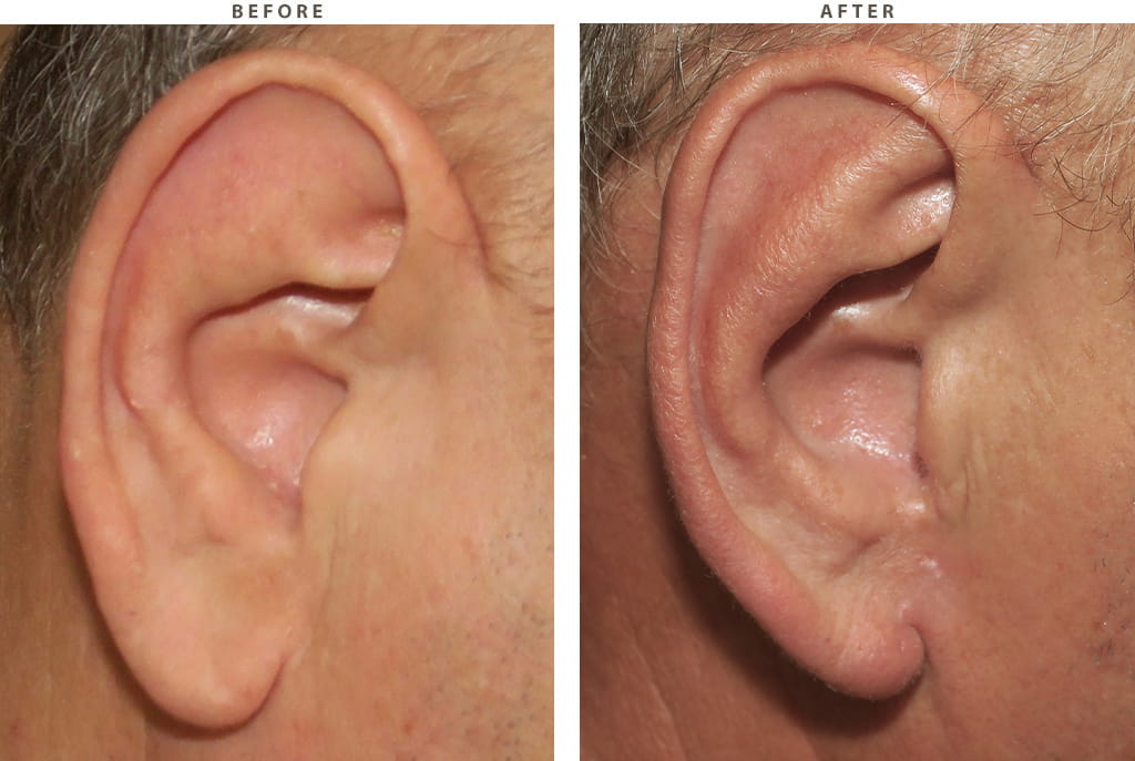 Earlobe reduction Chicago - Before and After Pictures