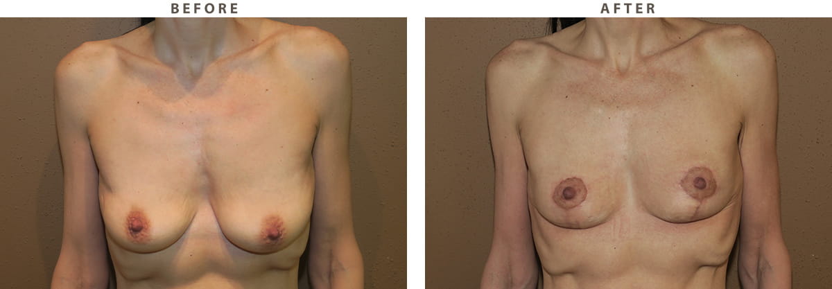 Breast Lift Chicago - Before and After Pictures