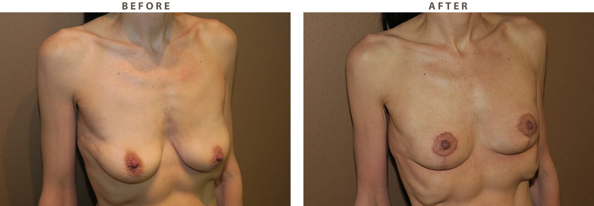 Breast Lift Chicago - Before and After Pictures