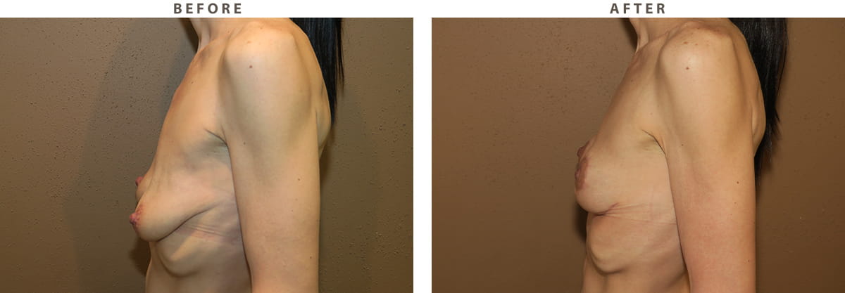 Breast Lift Chicago - Before and After Pictures