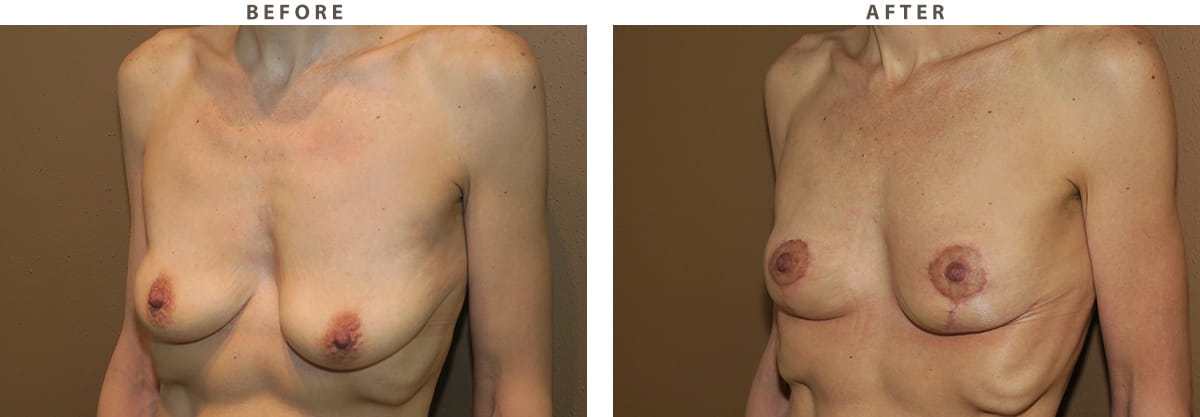 Breast Lift Chicago - Before and After Pictures