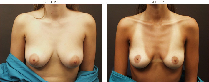 Areolar Reduction - Before and After Pictures
