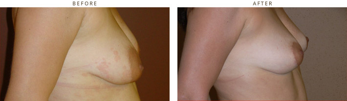Areolar Reduction - Before and After Pictures