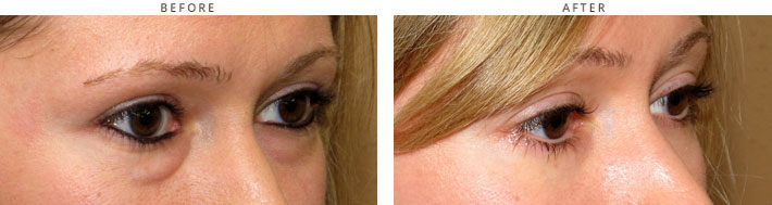 Eyelid lift surgery (blepharoplasty) - Before and After Pictures