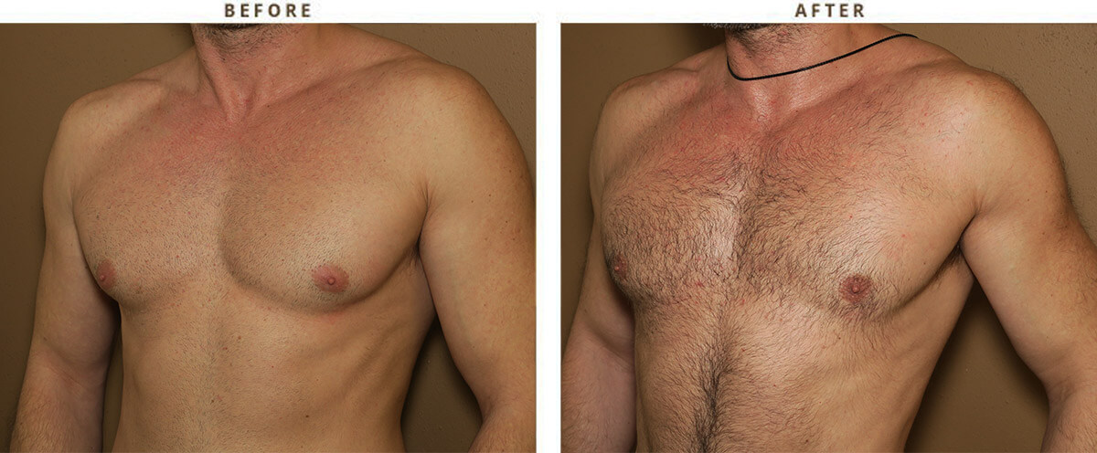 Gynecomastia Correction – Before and After Pictures