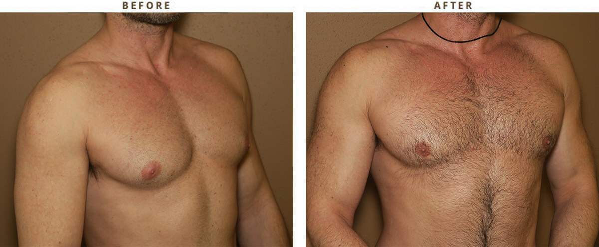 Gynecomastia Correction – Before and After Pictures