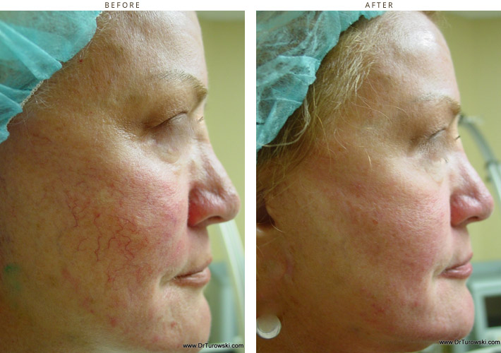Intense Pulse Light (ipl) – Before and After Pictures * | Dr Turowski