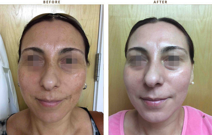 Rejuvenecimiento Facial: Luz Pulsada IPL- Oftalvist