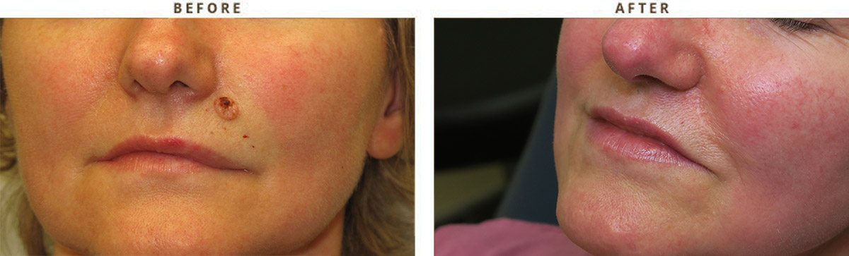 Skin Cancer - Before and After Pictures