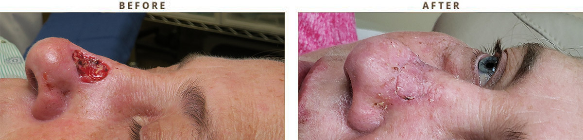 Skin Cancer (Treatment and Reconstruction)