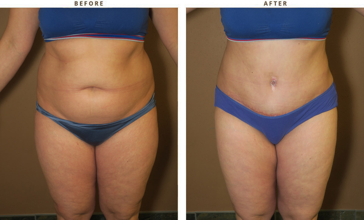 Tummy tuck and liposuction of abdomen, thighs and flanks. 
