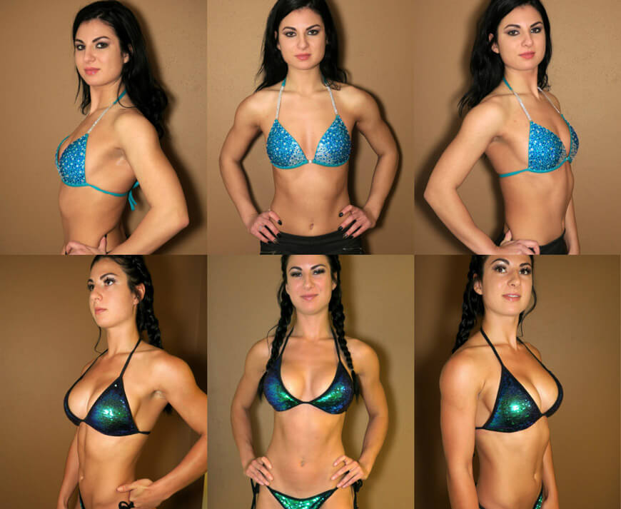 Our patient who is a body building champion enjoys her new body shape after...