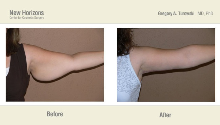 Arm Lift Before and After Photos - Dr Ali