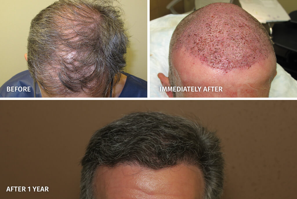 FUE Hair Transplantation – Before and After Pictures * | Dr Turowski - Plastic  Surgery Chicago
