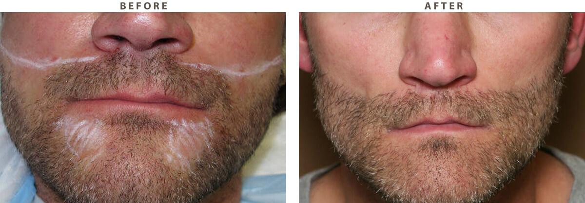 Artas Hair Transplant - Before and After Pictures