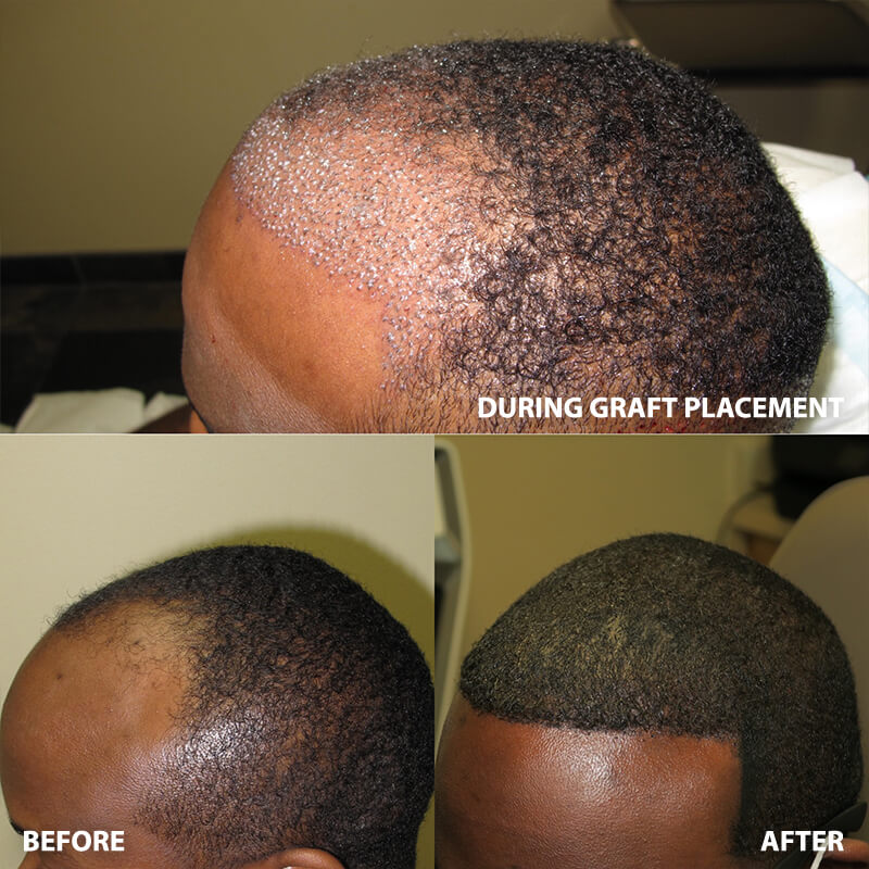 ARTAS Hair Restoration - Before and After Pictures