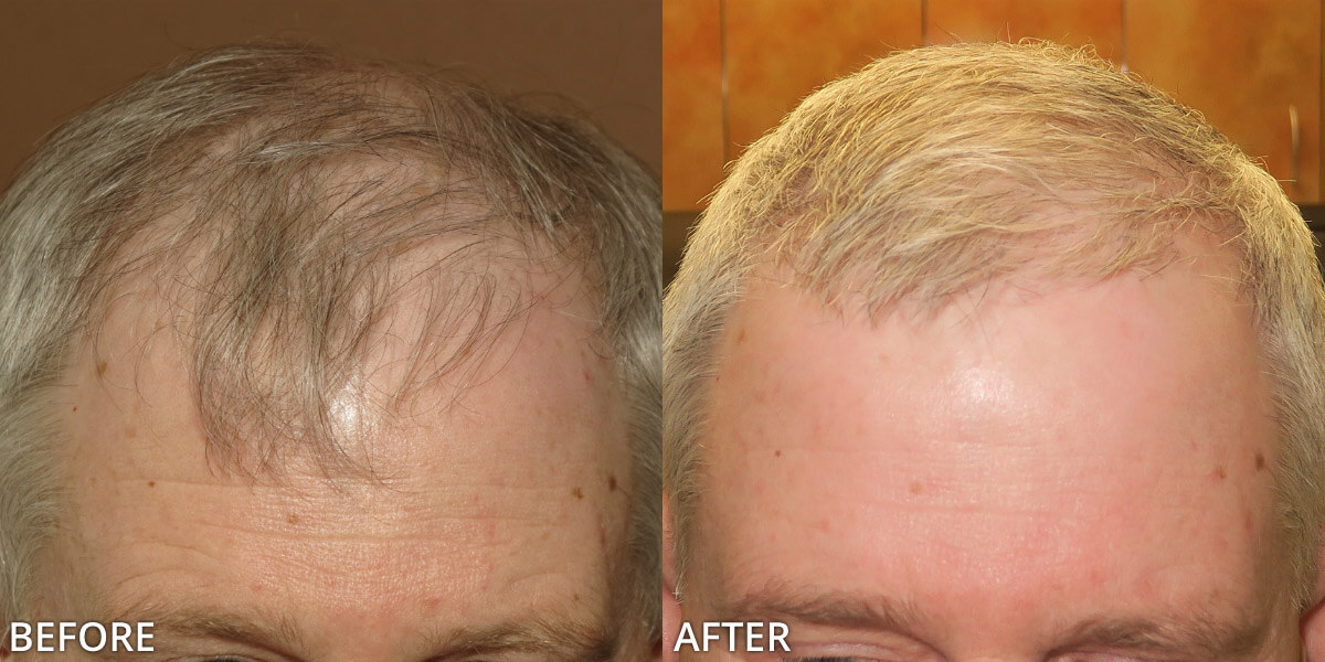 FUE Hair Transplantation – Before and After Pictures