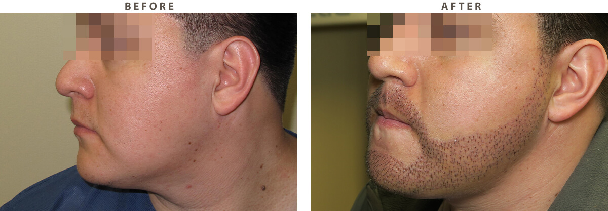 Facial Hair Transplant – Before and After Pictures * | Dr Turowski -  Plastic Surgery Chicago