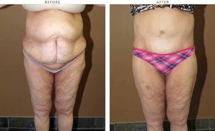 Results - Belt Lipectomy Surgery Before and After