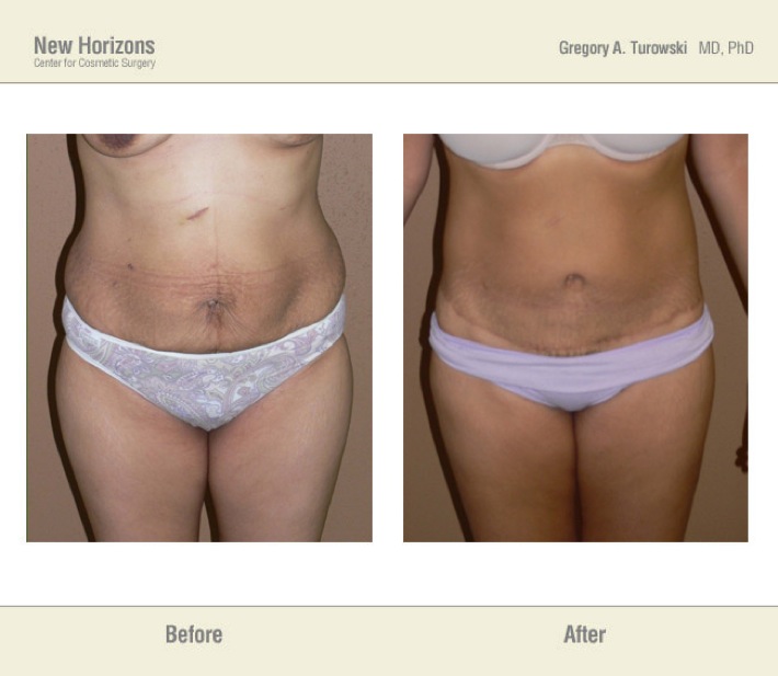 Belt Lipectomy Before and After 03