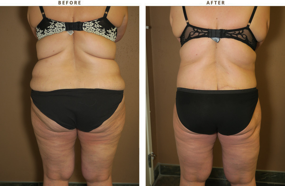 https://drturowski.com/wp-content/uploads/belt-lipectomy-lift-before-and-after-pictures-41.jpg