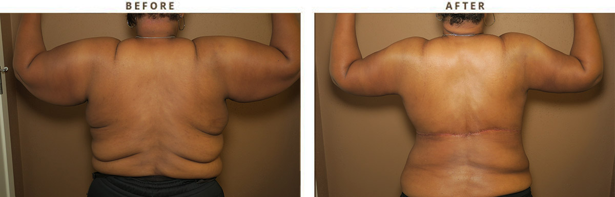 Belt Lipectomy in San Francisco Before & After - Body Lift