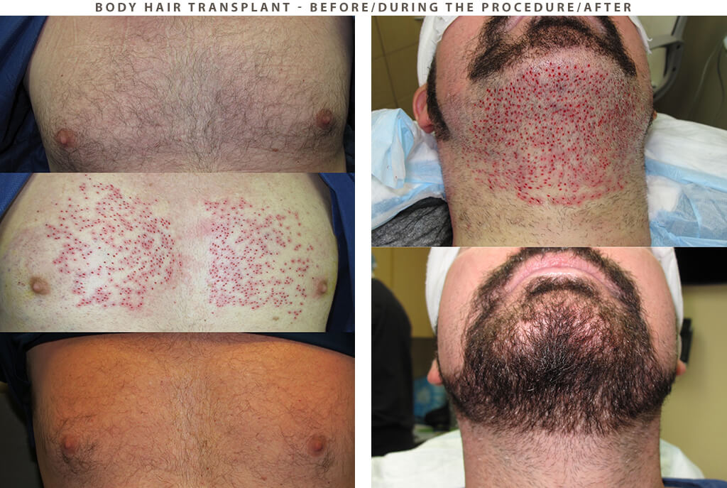 Body Hair Transplant - Before and After Pictures