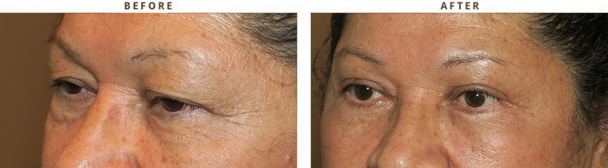Eyelid lift surgery (blepharoplasty) – Before and After Pictures
