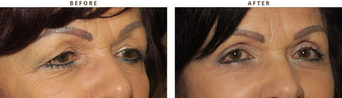 Eyelid lift surgery – Before and After Pictures
